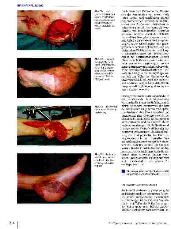 Vorschauseite 5: Die Indikation zur Amputation in der modernen Traumatologie und septischen Knochenchirurgie
