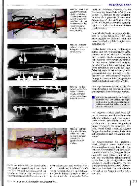 Vorschauseite 6: Die Indikation zur Amputation in der modernen Traumatologie und septischen Knochenchirurgie