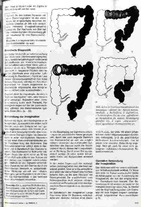 Vorschauseite 2: Akute Darminvagination Invagination enterica acuta