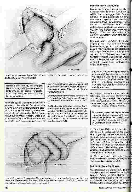 Vorschauseite 3: Akute Darminvagination Invagination enterica acuta