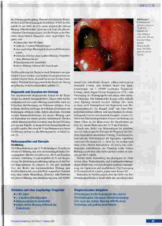 Vorschauseite 3: Effiziente Diagnostik und Therapie oberer gastrointestinaler Blutungen