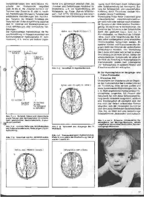 Vorschauseite 2: Themen aus der Neurochirurgie 16. Folge: Der Hydrozephalus