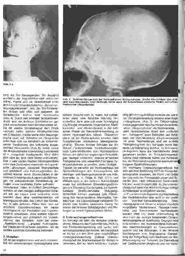 Vorschauseite 3: Themen aus der Neurochirurgie 16. Folge: Der Hydrozephalus