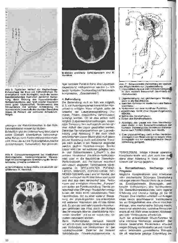 Vorschauseite 4: Themen aus der Neurochirurgie 16. Folge: Der Hydrozephalus
