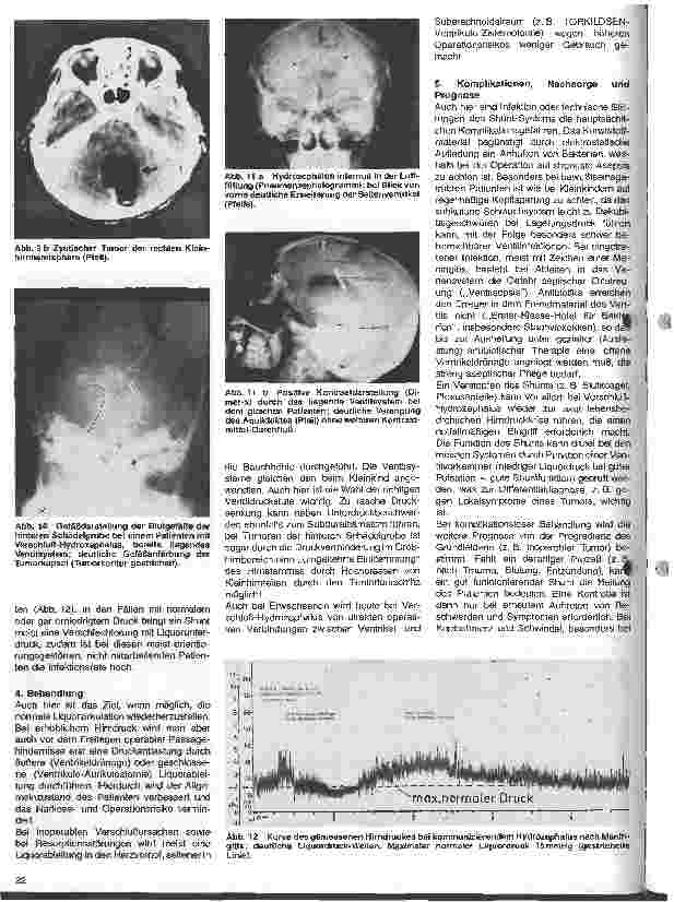 Vorschauseite 6: Themen aus der Neurochirurgie 16. Folge: Der Hydrozephalus