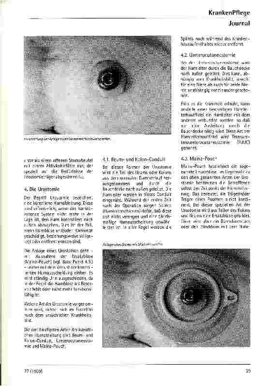Vorschauseite 3: ...und das Leben geht weiter! Das Stoma und dessen Versorgung