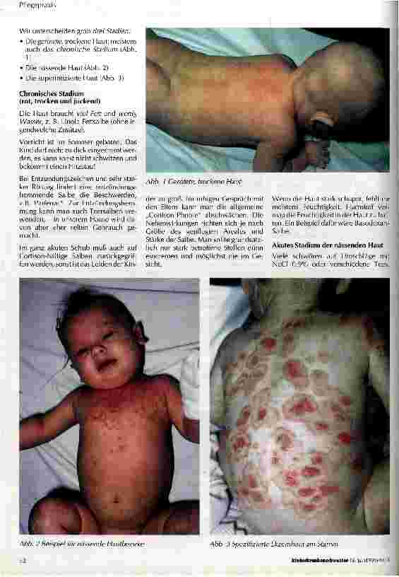 Vorschauseite 2: Neurodermitis - Endogenes Ekzem - Atopische Dermatitis - Atopisches Ekzem