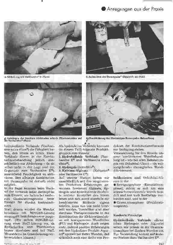 Vorschauseite 3: Kombination der Dermapulse-Behandlung mit hydroaktiven Verbänden Ein Erfahrungsbericht über eine modifizierte Wundbehandlungsmethode bei Dekubital-Ulcera