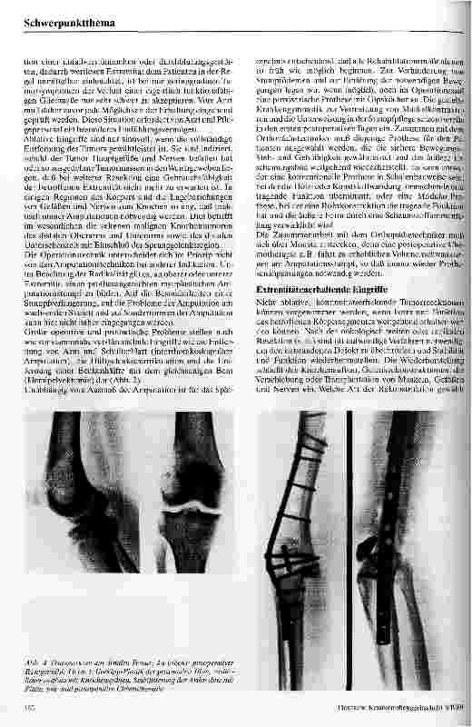 Vorschauseite 4: Die chirurgische Therapie bösartiger Knochentumoren