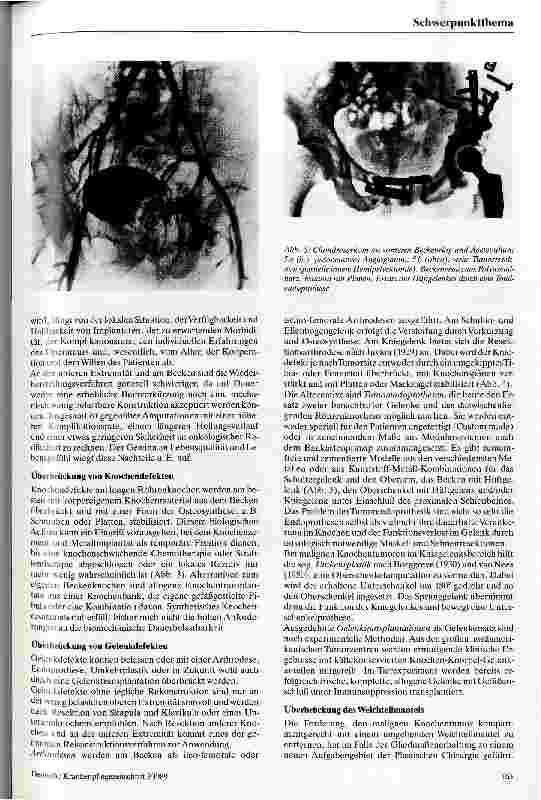 Vorschauseite 5: Die chirurgische Therapie bösartiger Knochentumoren