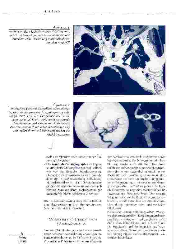 Vorschauseite 3: DIE AKUTE SUBARACHNOIDALBLUTUNG NACH ANEURYSMARUPTUR: MIKROCHIRURGISCHES CLIPPING VERSUSENDOVASKULÄRES COILING