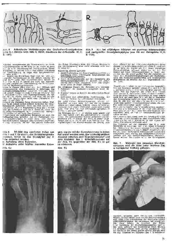 Vorschauseite 2: Grundlagen und Technik des Gipsverbandes 10. Folge: Fußgips nach OP eines Hallux valgus nach Brandes