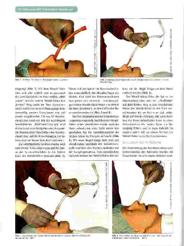 Vorschauseite 2: Nasotracheale Intubation in der Mund-, Kiefer-und Gesichtschirurgie