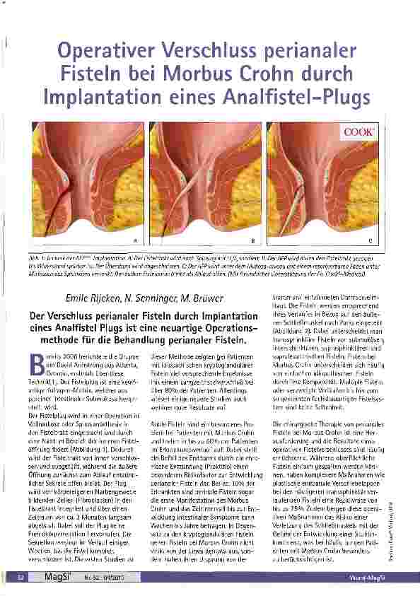 Vorschauseite 1: Operativer Verschluss perianaler Fisteln bei Morbus Crohn durch Implantation eines Analfistel-Plugs