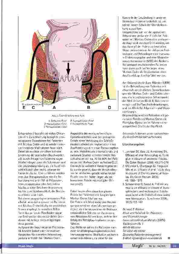 Vorschauseite 2: Operativer Verschluss perianaler Fisteln bei Morbus Crohn durch Implantation eines Analfistel-Plugs