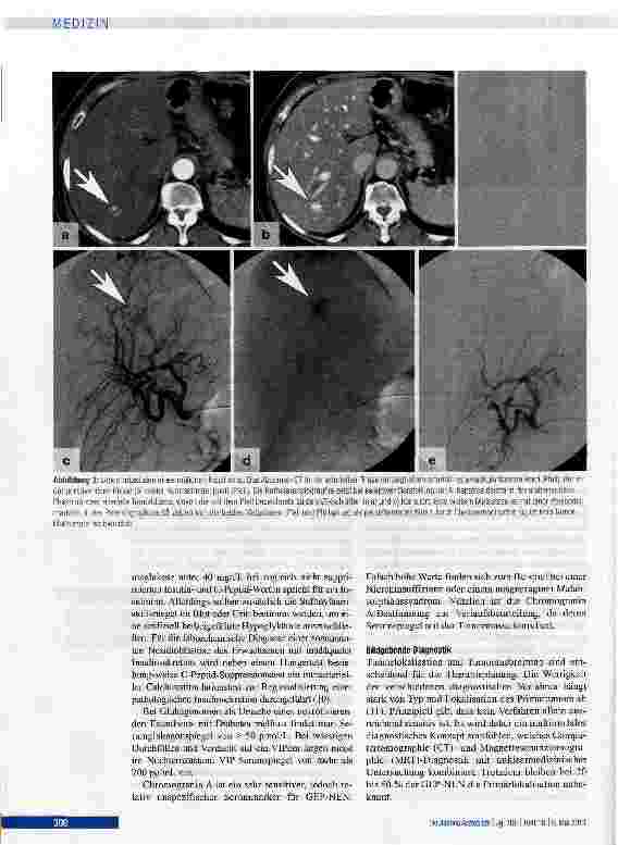 Vorschauseite 4: Gastroenteropankreatische neuroendokrine Neoplasien