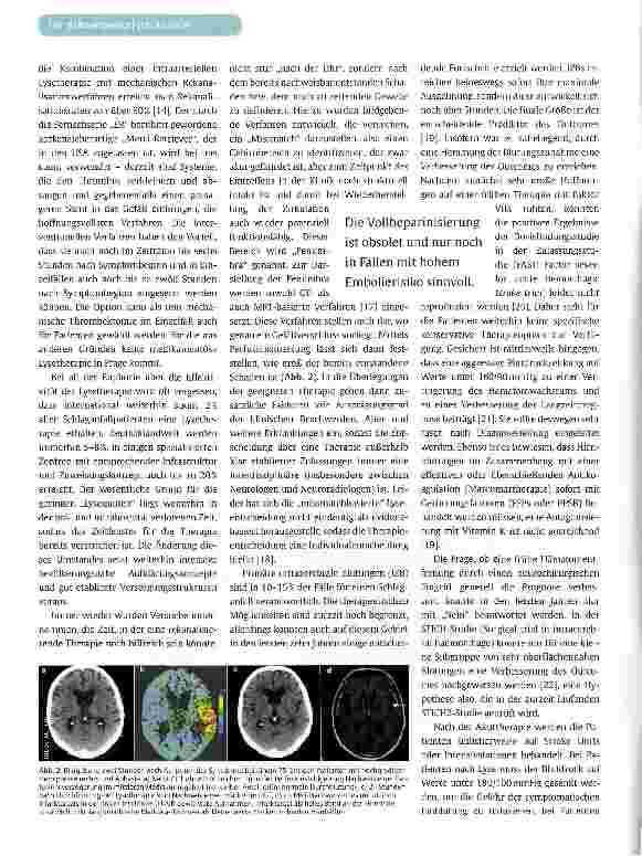 Vorschauseite 4: Akuttherapie des Schlaganfalls