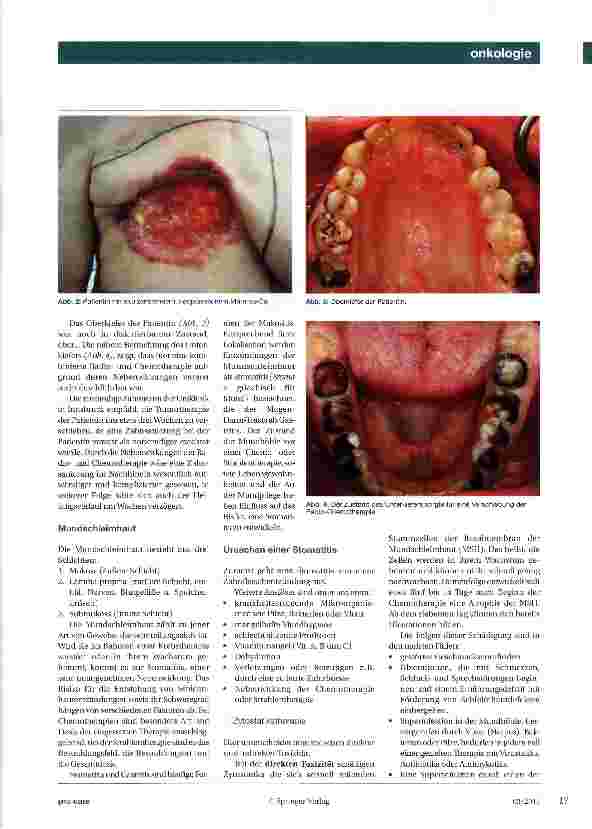 Vorschauseite 2: Prävention der Stomatitis