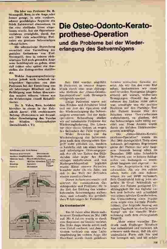 Vorschauseite 1: Die Osteo-Odonto-Kerato-prothese-Operation und die Probleme bei der Wiedererlangung des Sehvermögens