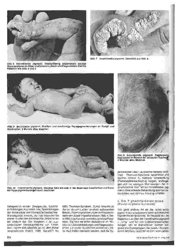 Vorschauseite 3: Hautärztliche Blick-Diagnose von Erbkrankheiten: Erbliche Störungen der Pigmentbildung