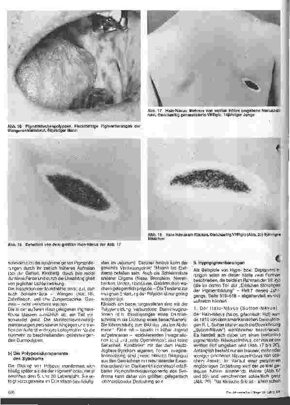 Vorschauseite 5: Hautärztliche Blick-Diagnose von Erbkrankheiten: Erbliche Störungen der Pigmentbildung