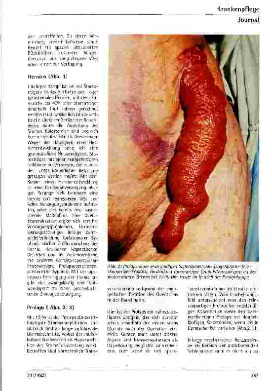 Vorschauseite 2: Komplikationen und Therapie bei Kolound Ileostomien