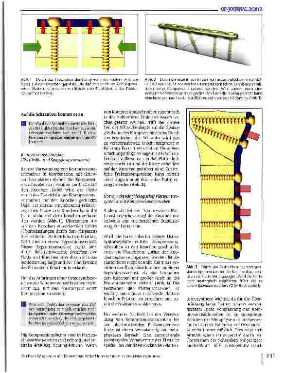 Vorschauseite 2: Biomechanische Unterschiede in der Osteosynthese zwischen Kompressionsplatten und Überbrückungsplatten
