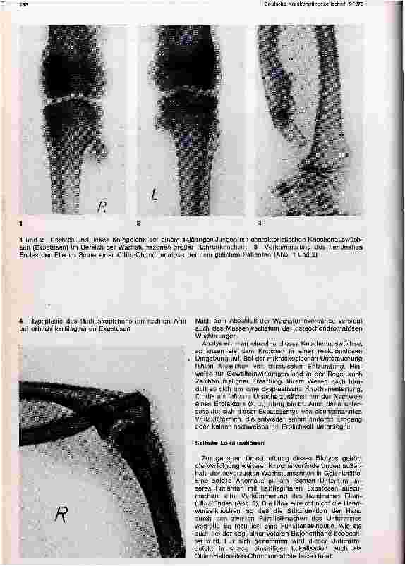 Vorschauseite 2: Röntgenbefunde bei erblich kartilaginären Exostosen
