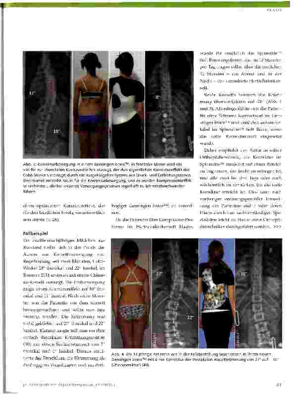 Vorschauseite 3: »Soft Braces« in der Skoliosebehandlung
