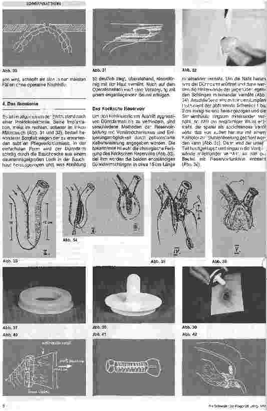 Vorschauseite 5: Stomaversorgung/Das Stoma/Indikationen, Methoden, Arten