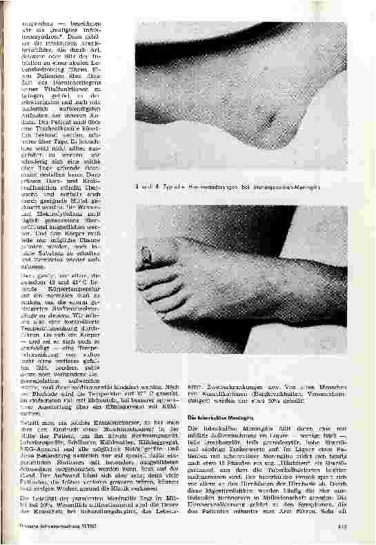 Vorschauseite 4: Die Formen der Meningitis und ihre Behandlung