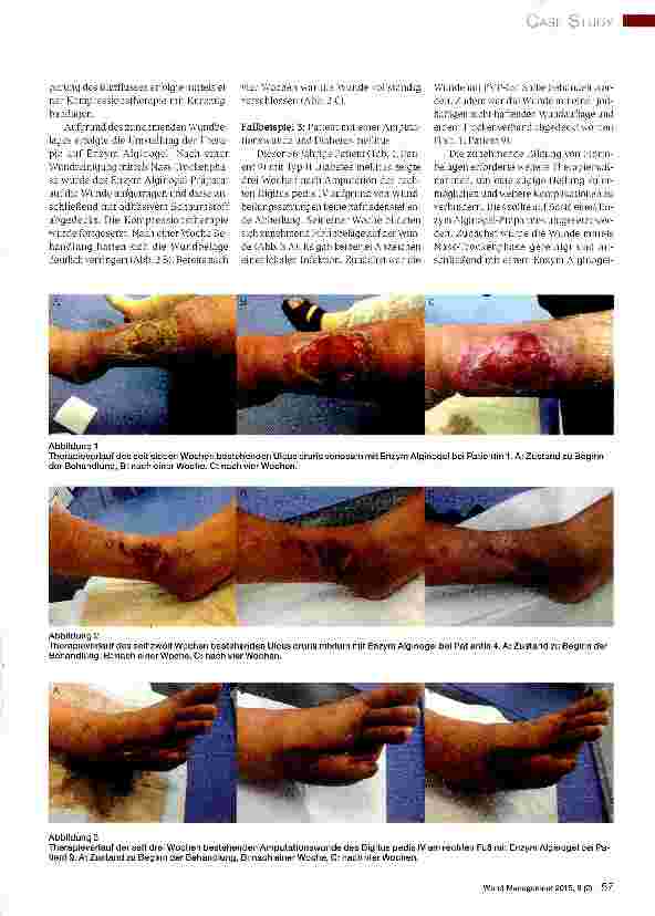 Vorschauseite 4: Der Einsatz von Enzym Alginogelen in der Therapie schwer heilender chronischer Wunden