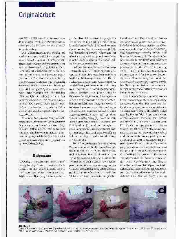 Vorschauseite 3: Erfolgreiche Therapie peristomaler postoperativer Wundheilungsstörungen mittels Vakuumversiegelung