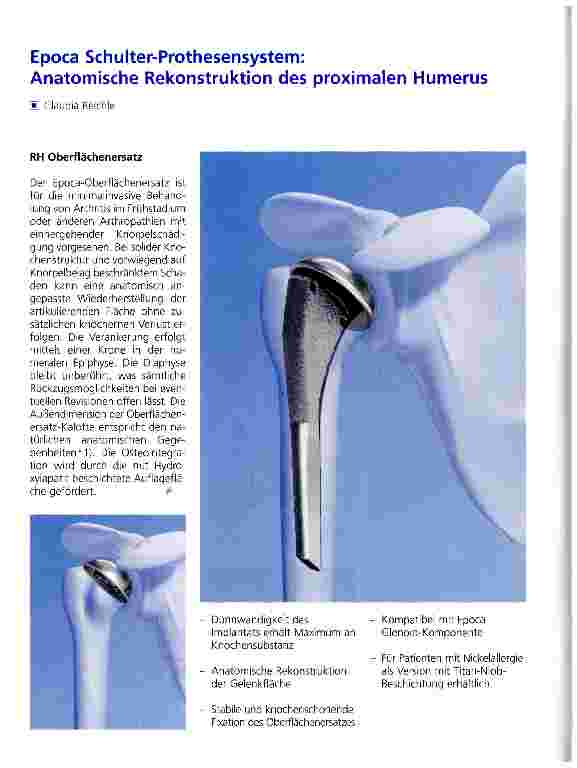Vorschauseite 1: Epoca Schulter-Prothesensystem:Anatomische Rekonstruktion des proximalen Humerus