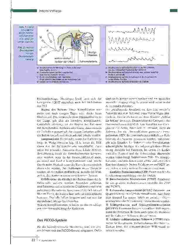 Vorschauseite 2: Pulmonaliskatheter und PiCCOFreund oder Feind?