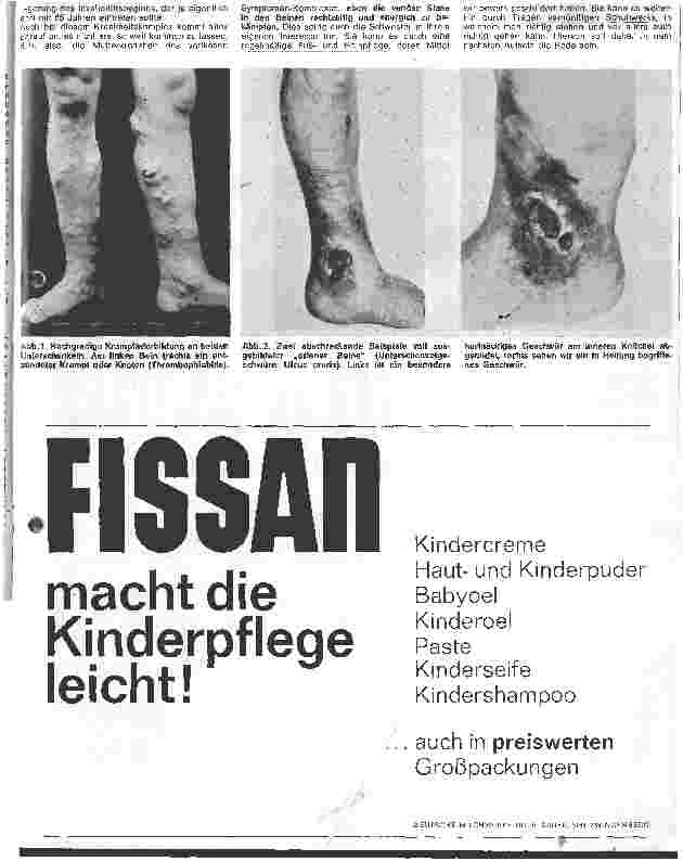 Vorschauseite 2: Was versteht man unter dem varikösen Symtomen-Komplex?