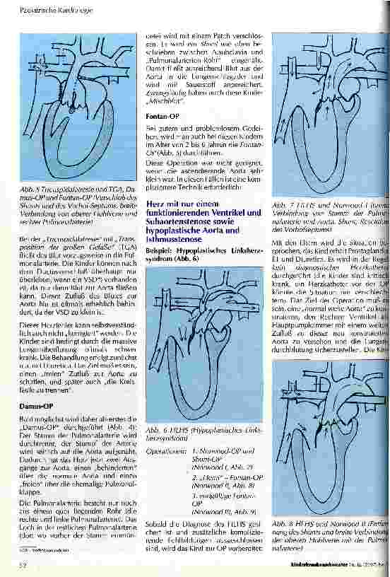 Vorschauseite 3: Operative Möglichkeiten bei angeborenen Herzfehlern mit nur einer Herzkammer - speziell beim Hypoplastischen Linksherzsyndrom (HLPS)
