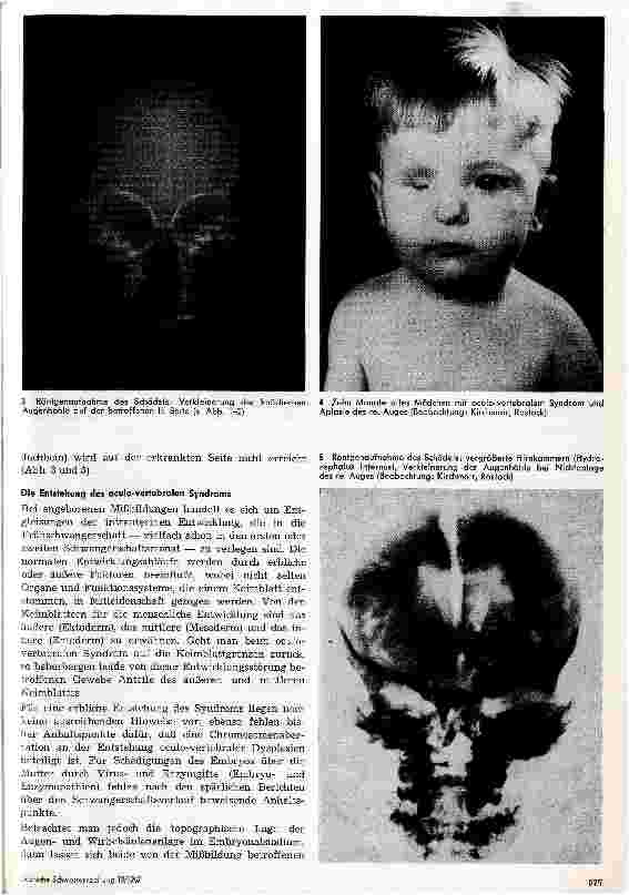 Vorschauseite 3: Zur Klinik und Pathologie des oculo-vertebralen Syndroms