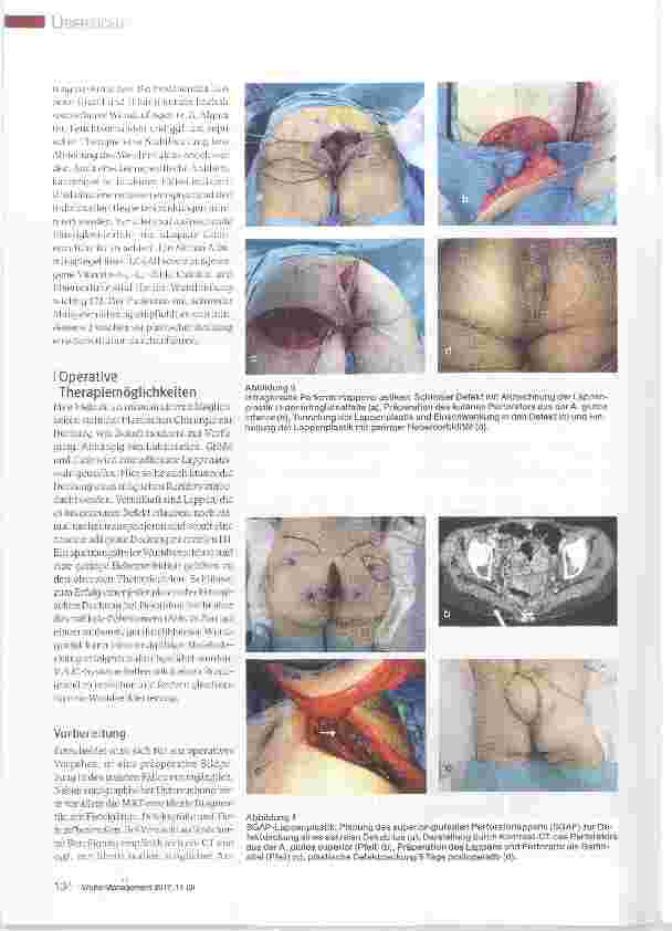 Vorschauseite 3: Rekonstruktive Optionen durch die Plastische Chirurgie in der Therapie des Dekubitus
