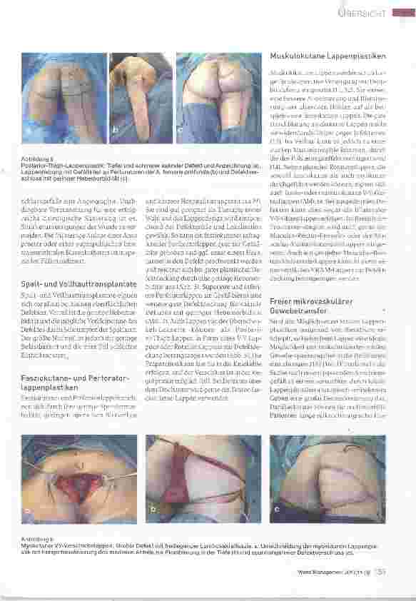 Vorschauseite 4: Rekonstruktive Optionen durch die Plastische Chirurgie in der Therapie des Dekubitus