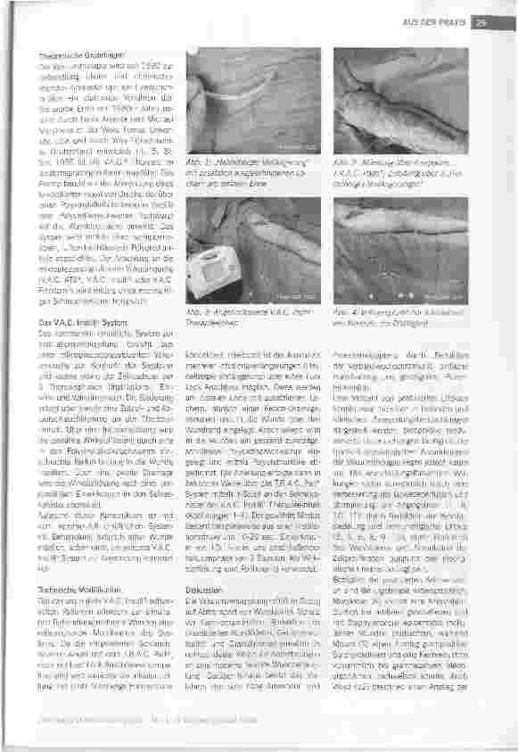 Vorschauseite 2: Technische Modifikation der V.A.C. Instill® zur simultanen Behandlung von infizierten Wunden unterschiedlicher Lokalisation