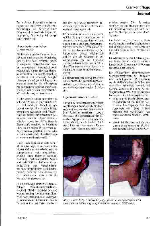 Vorschauseite 3: Die lokale Therapie chronisch-arterieller Ulcera cruris mit thrombocytären Wachstumsfaktoren