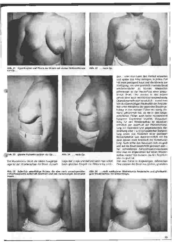 Vorschauseite 5: Die plastische Wiederherstellungschirurgie 5. Folge: Plastische und wiederherstellende Operationen der Brust