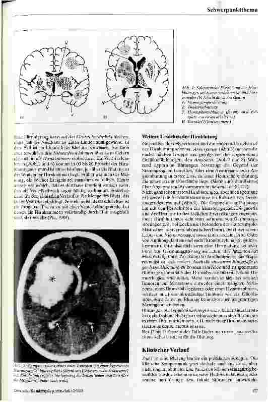 Vorschauseite 2: Spontane Hirnblutungen