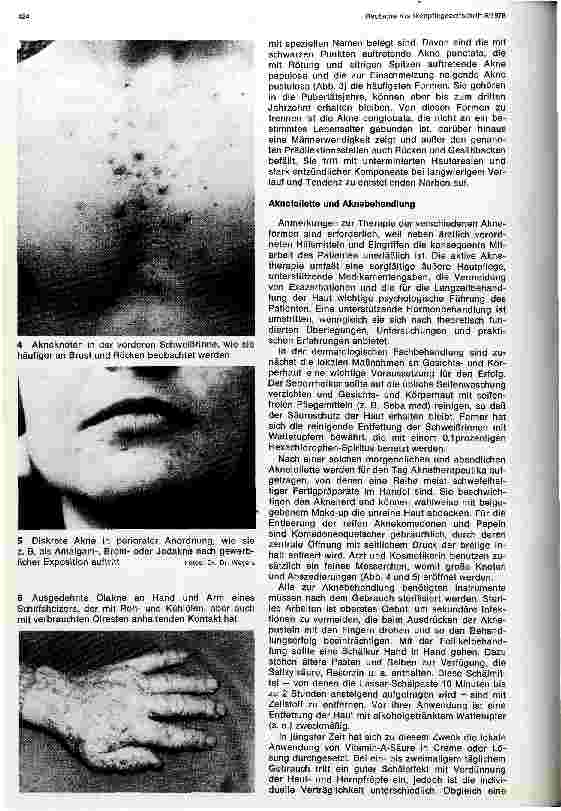 Vorschauseite 2: Akne juvenilis und Akne-Sonderformen