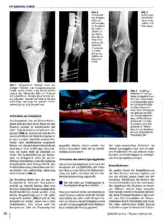 Vorschauseite 3: Fixateur externe bei Korrekturoperationen und Arthrodesen