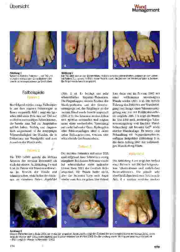 Vorschauseite 3: Thrombangiitis obliterans oder Bürger sche Krankheit