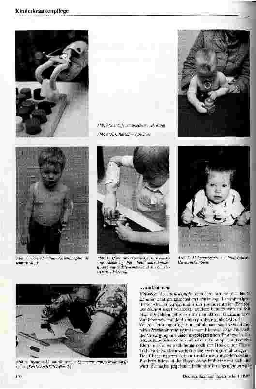 Vorschauseite 2: Prothetische Versorgung von Kindern mit Fehlbildungen der Extremitäten