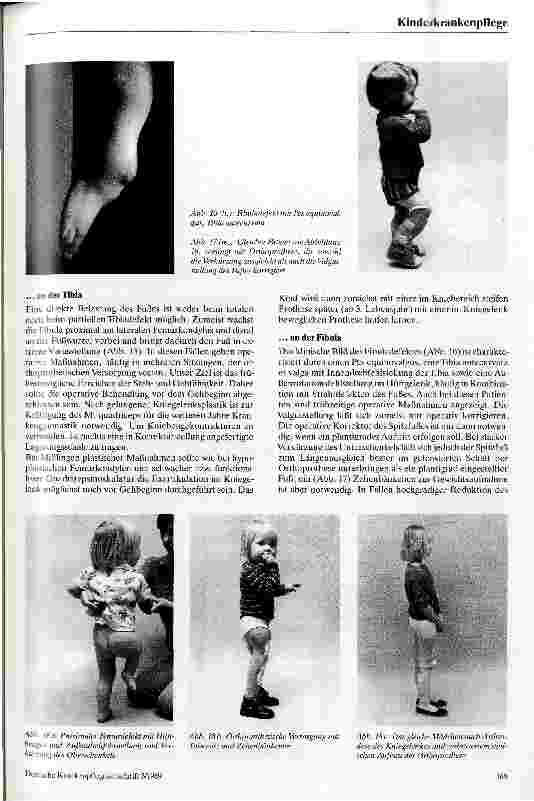 Vorschauseite 5: Prothetische Versorgung von Kindern mit Fehlbildungen der Extremitäten