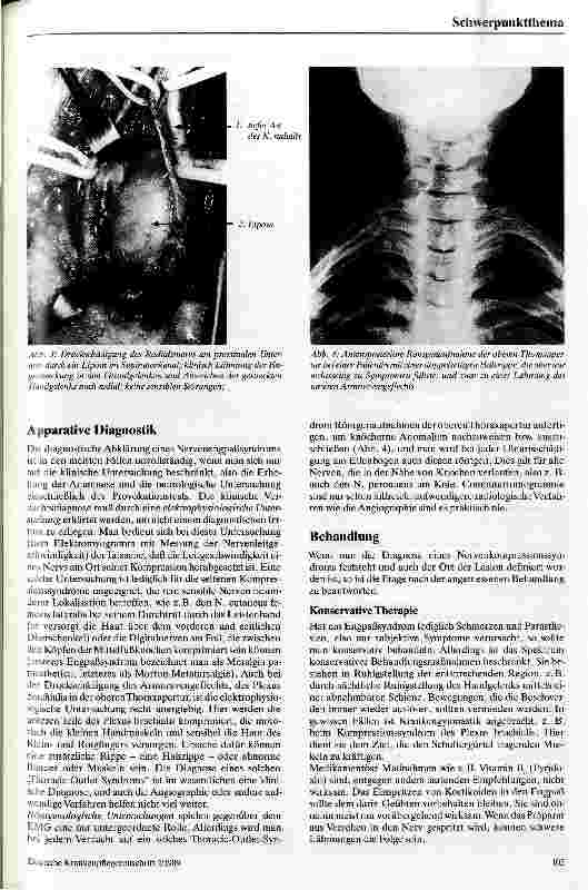 Vorschauseite 3: Kompressionssyndrome peripherer Nerven
